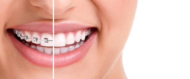 braces in flushing and great neck